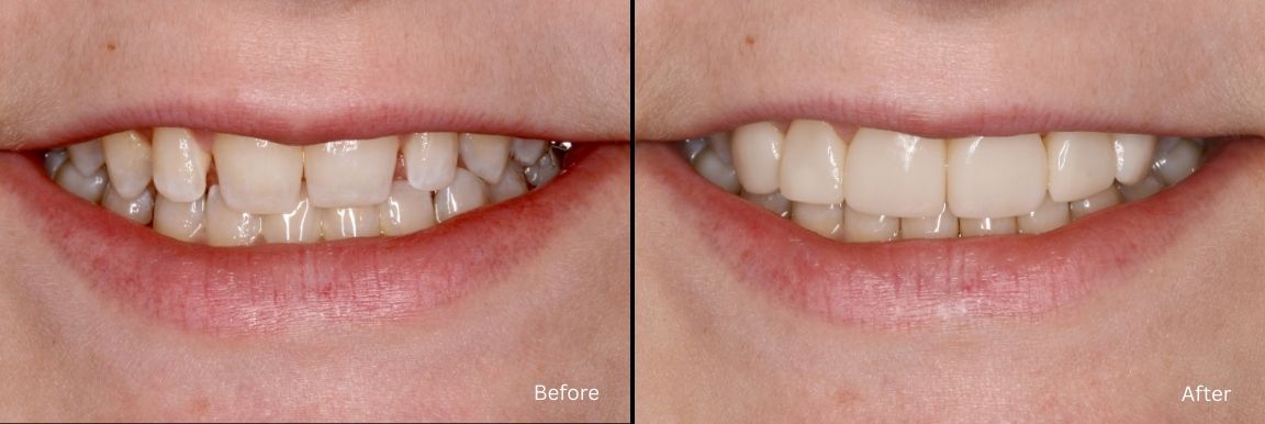 Smile Transformation