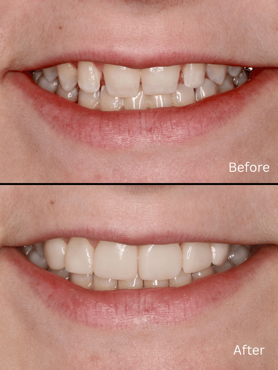 Smile Transformation