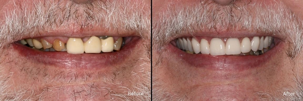 Cosmetic Dentistry Result