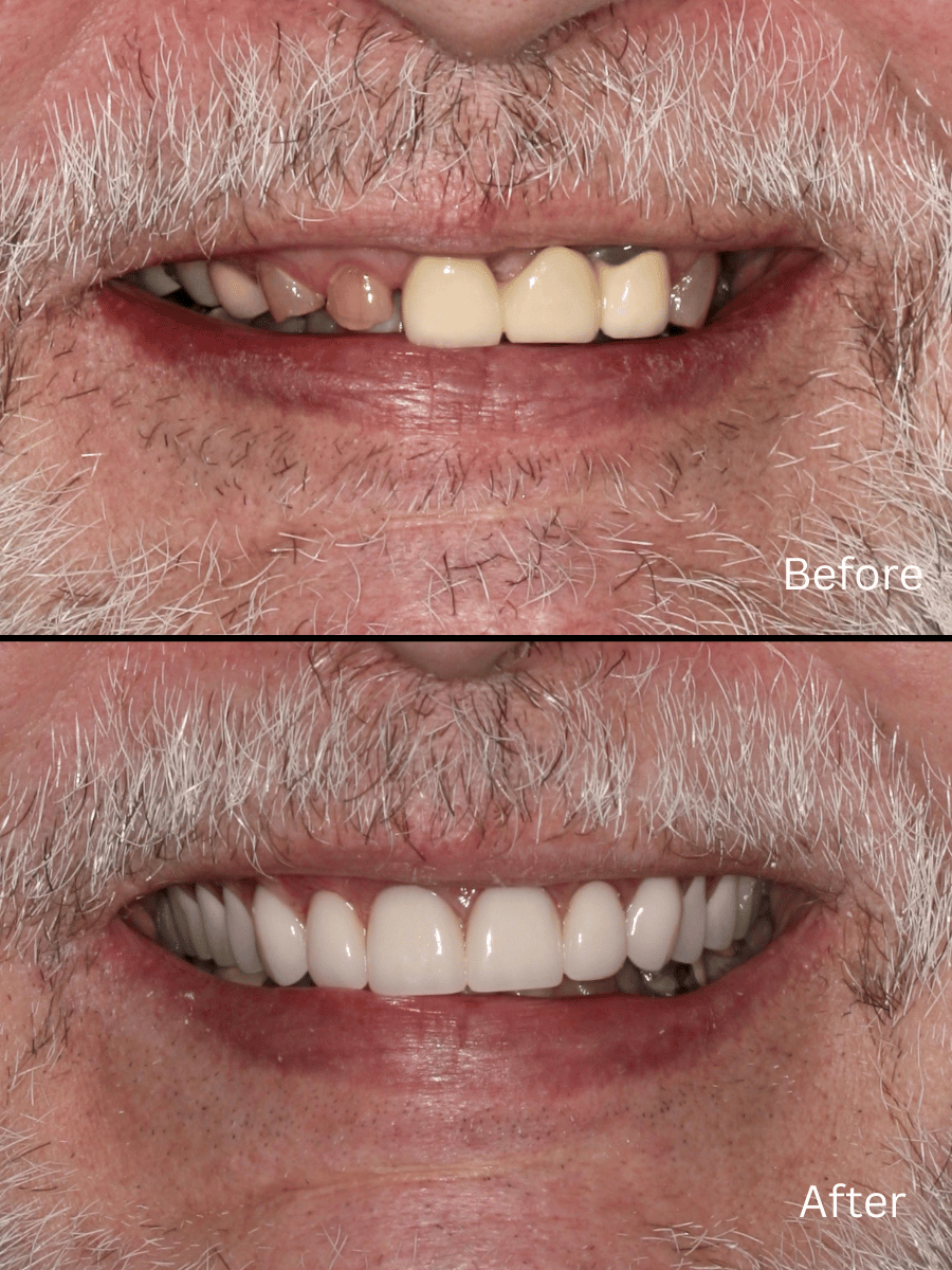 Cosmetic Dentistry Result
