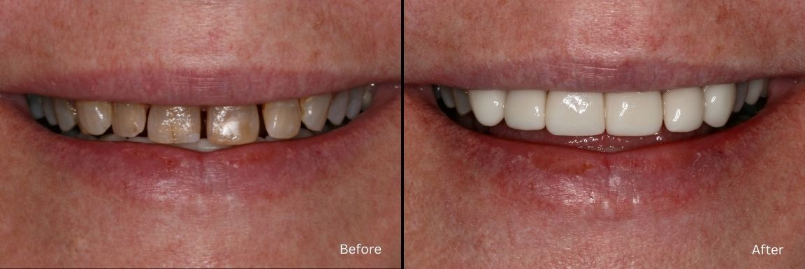 Patient Smile Makeover